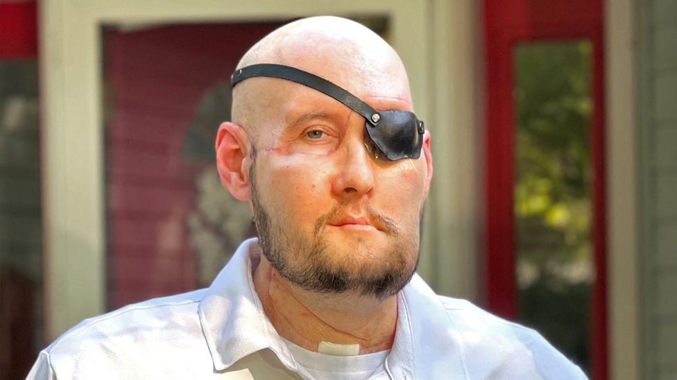 US veteran makes remarkable progress after world's first eye transplant