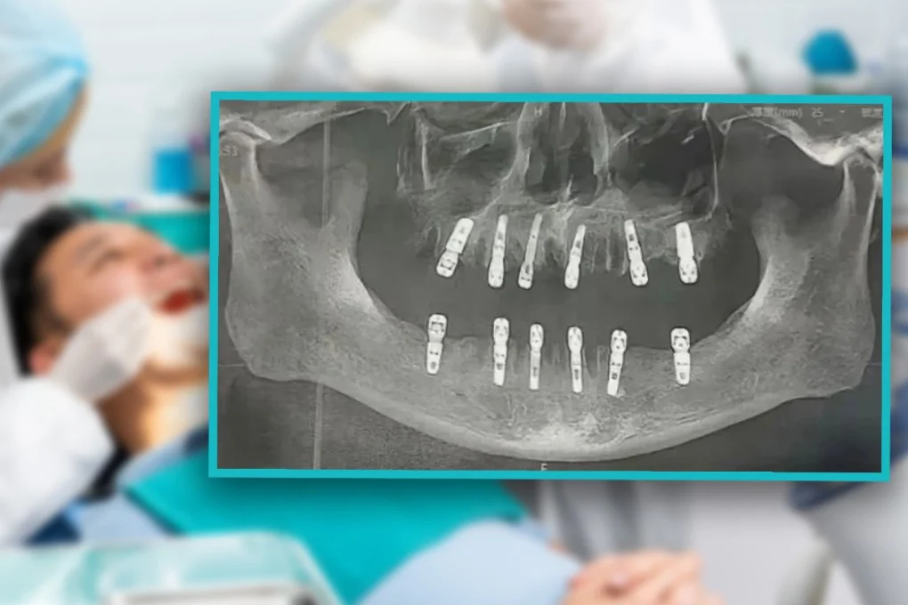 Chinese man dies of heart attack after undergoing 23 teeth extractions, 12 implants in one day