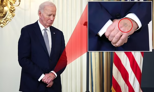 Purple 'bruise' on Joe Biden's hand during White House event sparks speculation