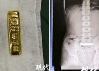 A curious case: boy swallows solid gold bar